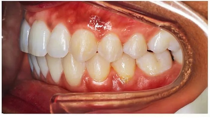 Orthodontie adulte résultat